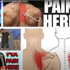 Douleur interscapulaire, symptôme de déchirure du muscle rhomboïde. Visualisation de la douleur et des solutions.