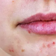 Gros plan sur une bouche et un menton présentant des rougeurs et des micro kystes sur le visage.