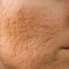Gros plan sur une joue présentant une peau granuleuse et des cicatrices d'acné, révélant une texture irrégulière.