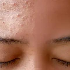 Gros plan sur le front d'une personne, montrant plusieurs petits boutons et une peau texturée. Les sourcils et les cils sont visibles.