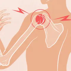 Douleur vive à l'épaule et au dos, le muscle tendu irradie. Le squelette de l'épaule est mis en évidence.