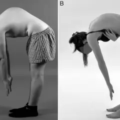 Deux individus se penchent en avant. L'image A montre une cyphose dorsale normale chez un homme. L'image B montre une posture similaire chez une femme.