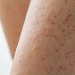 Gros plan sur une peau présentant de petites bosses rouges, typiques de la kératose pilaire.