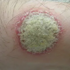 Gros plan d'une lésion cutanée circulaire sur la peau, avec une bordure rouge et une zone centrale squameuse et jaunâtre. Ce petit bouton sur le ventre qui ne gratte pas semble être une mycose.