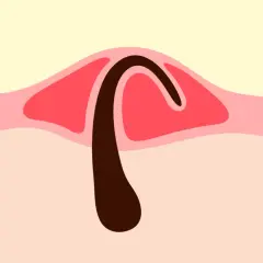 Illustration d'un poil incarné sous la peau, avec une partie sombre courbée sous une couche rouge.