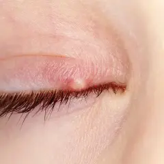 Gros plan d'un paupière avec un bouton blanc oeil, rouge et enflammé, près des cils.
