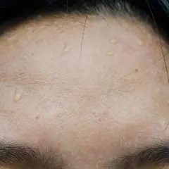 Gouttes de sueur sur le front, signe de transpiration excessive du visage après un effort.