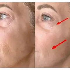 Avant/après : le masque LED a réduit les rides du visage, comme indiqué par les flèches rouges.