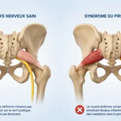 Comparaison anatomique : un muscle piriforme sain et un muscle piriforme contracturé comprimant le nerf sciatique, causant douleur et inflammation.