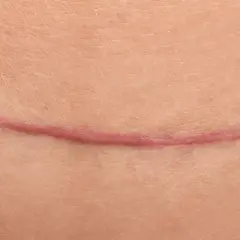 Des doigts écartent la peau pour révéler une cicatrice rosée. Un remède de grand-mère pour effacer les cicatrices, un espoir de guérison.