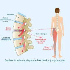 Schéma montrant une hernie discale comprimant le nerf sciatique, causant douleur irradiante dans le muscle fessier et la jambe.