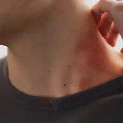 Une zone de peau rouge, peut-être une vergeture rouge, apparaît sur le cou d'une personne qui se gratte.