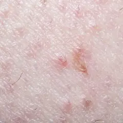 Gros plan sur la peau du pubis, montrant des rougeurs et des poils incarnés, signe d'une irritation cutanée.