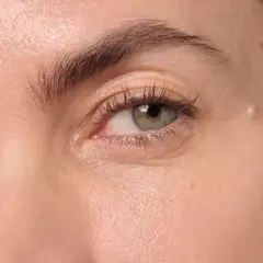 Gros plan sur un œil, montrant une peau claire avec une légère rougeur et une petite lésion, possiblement un psoriasis paupière.