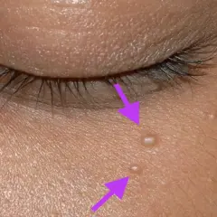 Flèches violettes pointant vers de petits points blancs sur la peau, indiquant un grain de milium près de l'œil.
