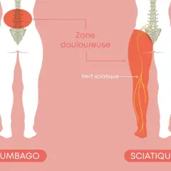 L'image illustre le lumbago et la sciatique, montrant une douleur le long de la colonne vertébrale et irradiant dans la jambe via le nerf sciatique.