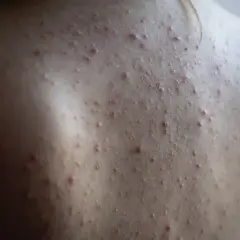 Gros plan sur le dos d'une personne présentant une acné du dos, avec de nombreux petits boutons rouges et blancs sur la peau.