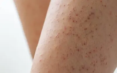 Gros plan sur une peau présentant de petites bosses rouges, typiques de la kératose pilaire.