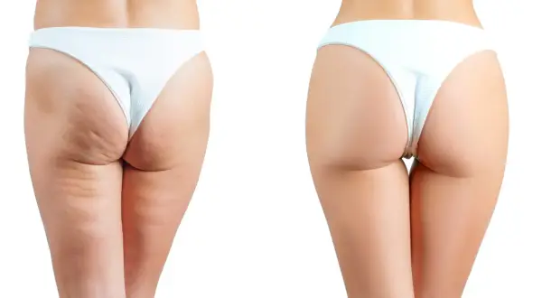 Comparaison avant/après : les fesses présentent une peau lisse et ferme, sans cellulite.
