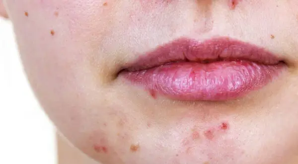 Gros plan sur une bouche et un menton présentant des rougeurs et des micro kystes sur le visage.