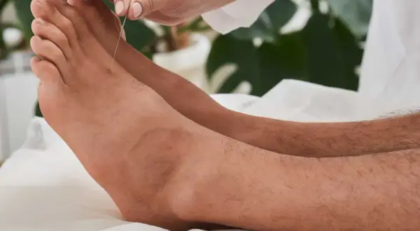 Acupuncture sur un pied, visant un point de pression pour un massage thérapeutique.