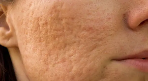 Gros plan sur une joue présentant une peau granuleuse et des cicatrices d'acné, révélant une texture irrégulière.