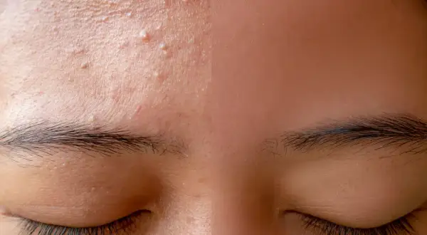 Gros plan sur le front d'une personne, montrant plusieurs petits boutons et une peau texturée. Les sourcils et les cils sont visibles.
