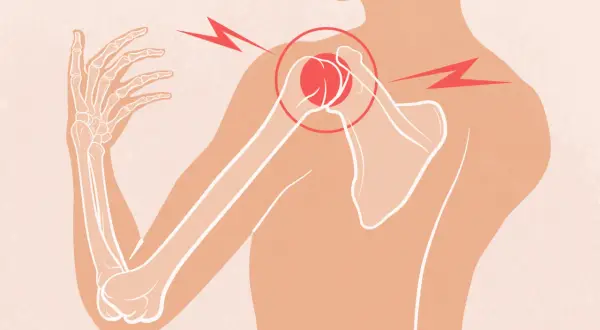 Douleur vive à l'épaule et au dos, le muscle tendu irradie. Le squelette de l'épaule est mis en évidence.