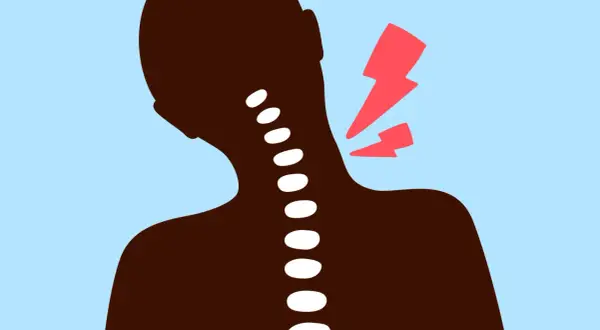 Silhouette d'une personne avec une colonne vertébrale visible, symbolisant une nuque bloquée et une douleur vive.