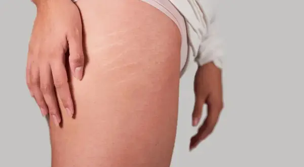 Gros plan sur la cuisse d'une personne, montrant des vergetures. La peau est légèrement rosée, avec des marques blanches caractéristiques des vergetures sur la cuisse.