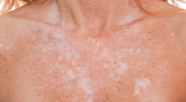 Poitrine et cou d'une personne présentant des taches blanches sur la peau, probablement dues à une exposition au soleil.