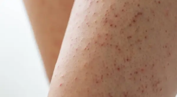 Gros plan sur une peau présentant de petites bosses rouges, typiques de la kératose pilaire.