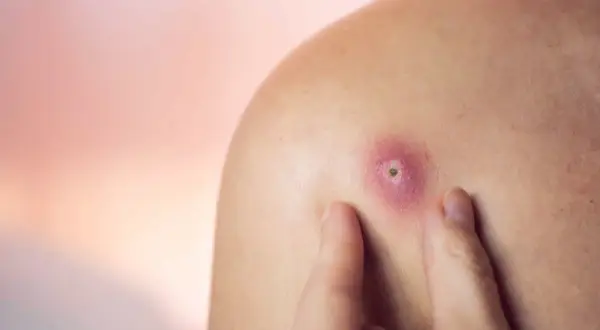 Un doigt touche un bouton rouge et enflammé sur une épaule, un bouton qui ne part pas et qui semble douloureux.
