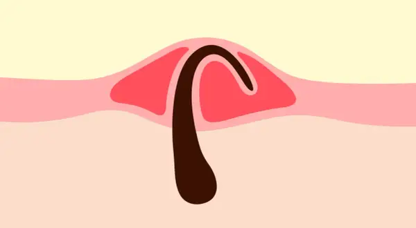Illustration d'un poil incarné sous la peau, avec une partie sombre courbée sous une couche rouge.