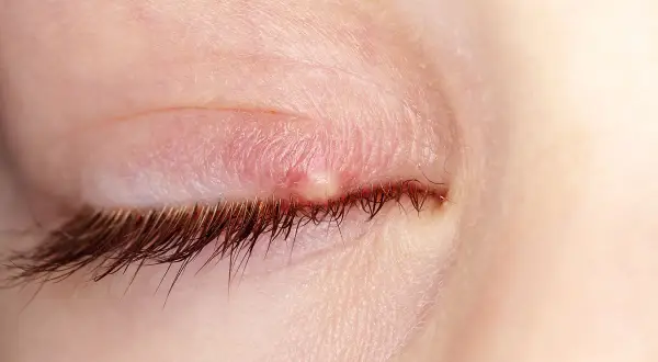 Gros plan d'un paupière avec un bouton blanc oeil, rouge et enflammé, près des cils.