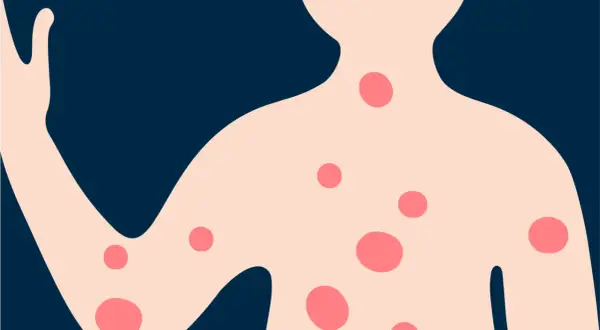 Illustration d'un torse et d'un bras avec des plaques rouges, évoquant l'eczéma sur le dos et le corps.