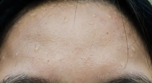Gouttes de sueur sur le front, signe de transpiration excessive du visage après un effort.