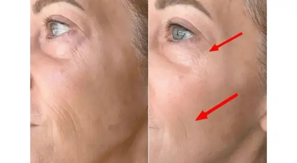 Avant/après : le masque LED a réduit les rides du visage, comme indiqué par les flèches rouges.