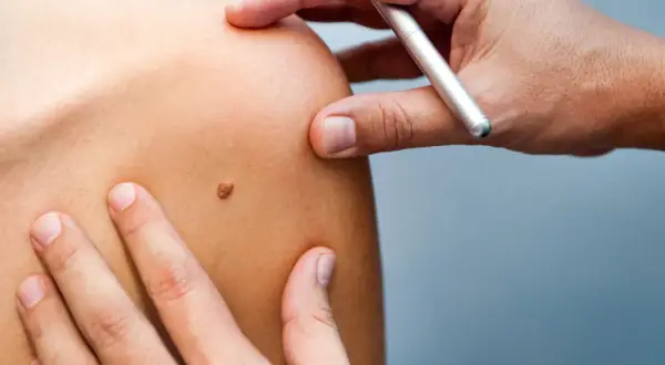 Un médecin examine un grain de beauté qui saigne sur l'épaule d'un patient.