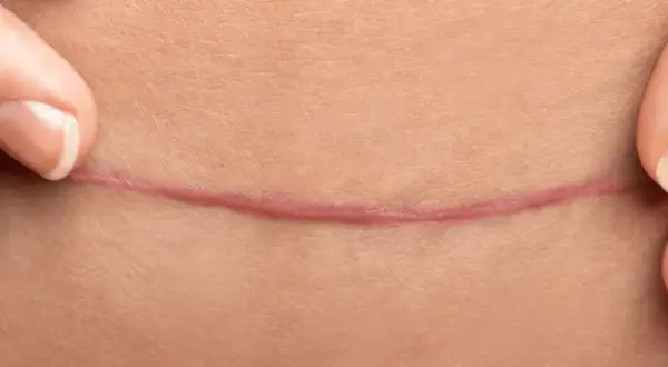 Des doigts écartent la peau pour révéler une cicatrice rosée. Un remède de grand-mère pour effacer les cicatrices, un espoir de guérison.