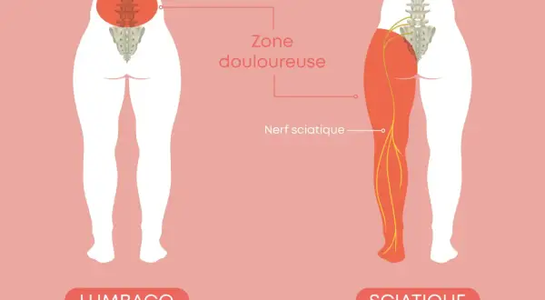 Illustration montrant la différence entre le lumbago et la sciatique, avec le nerf sciatique et la zone douloureuse.