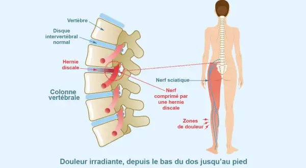 Schéma montrant une hernie discale comprimant le nerf sciatique, causant douleur irradiante dans le muscle fessier et la jambe.