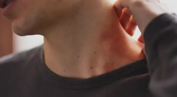 Une zone de peau rouge, peut-être une vergeture rouge, apparaît sur le cou d'une personne qui se gratte.