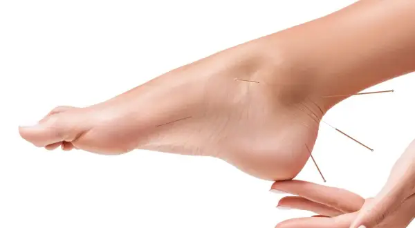 Acupuncture sur le pied pour soulager la douleur. Des aiguilles fines sont insérées sur le dessus et le talon du pied.