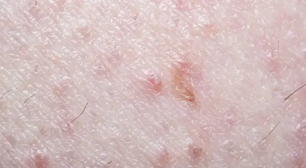 Gros plan sur la peau du pubis, montrant des rougeurs et des poils incarnés, signe d'une irritation cutanée.