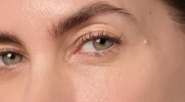 Gros plan sur un œil, montrant une peau claire avec une légère rougeur et une petite lésion, possiblement un psoriasis paupière.