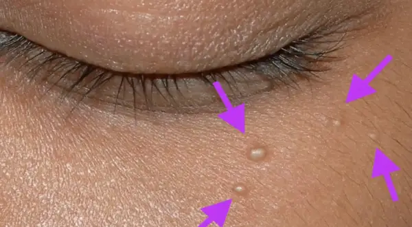 Flèches violettes pointant vers de petits points blancs sur la peau, indiquant un grain de milium près de l'œil.