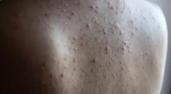 Gros plan sur le dos d'une personne présentant une acné du dos, avec de nombreux petits boutons rouges et blancs sur la peau.