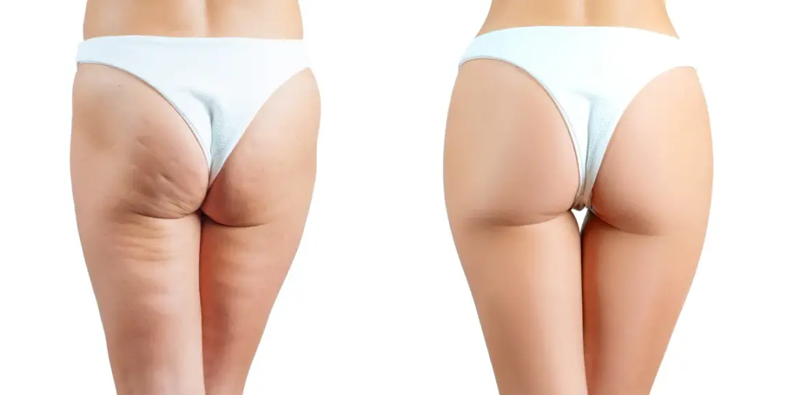 Comparaison avant/après : les fesses présentent une peau lisse et ferme, sans cellulite.