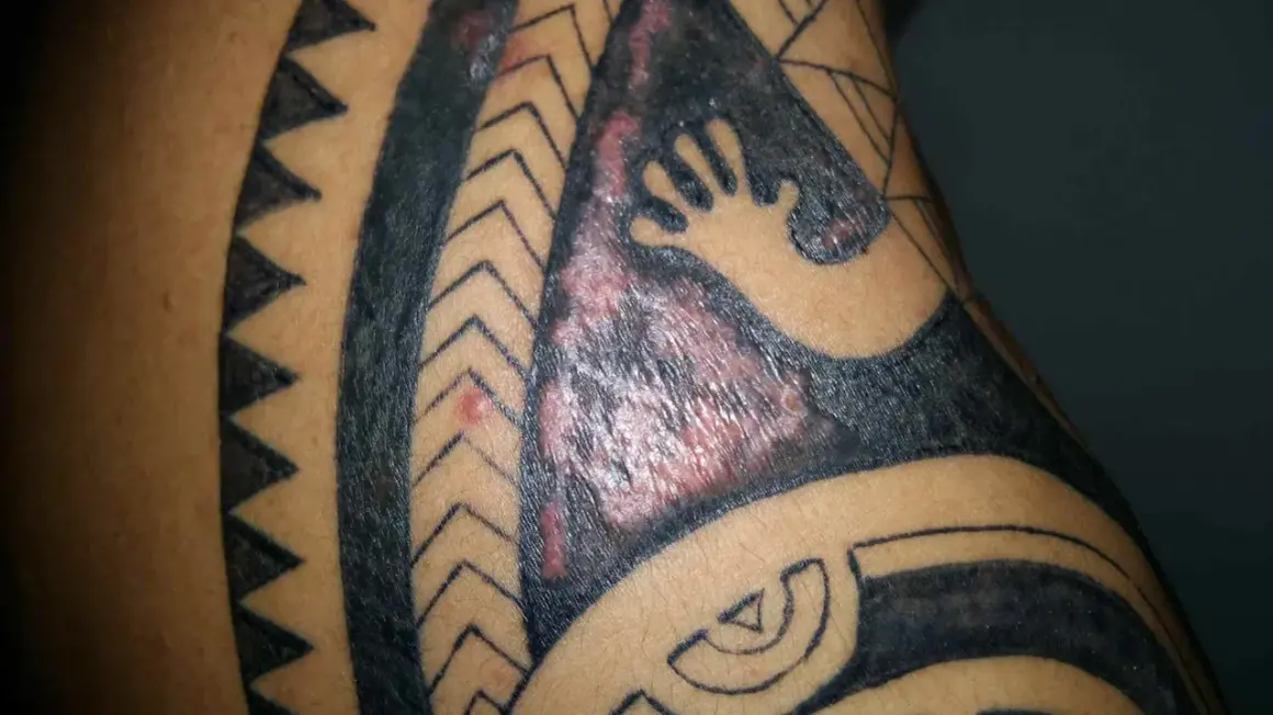 Gros plan sur un tatouage tribal qui gratte, avec des zones rouges et enflammées sur la peau.